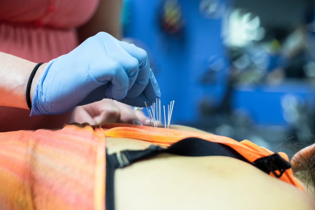 dry needling at movement physical therapy, chicago